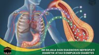 Gejala dan Diagnosis Nefropati Diabetik