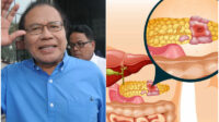 Kanker Pankreas Yang Diderita Rizal Ramli