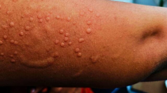 Waspada Mpox Atau Monkeypox