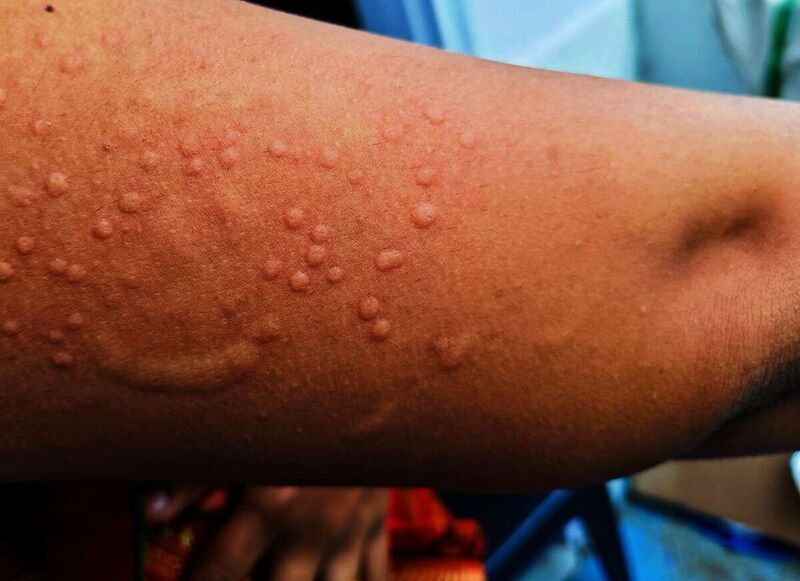 Waspada Mpox Atau Monkeypox